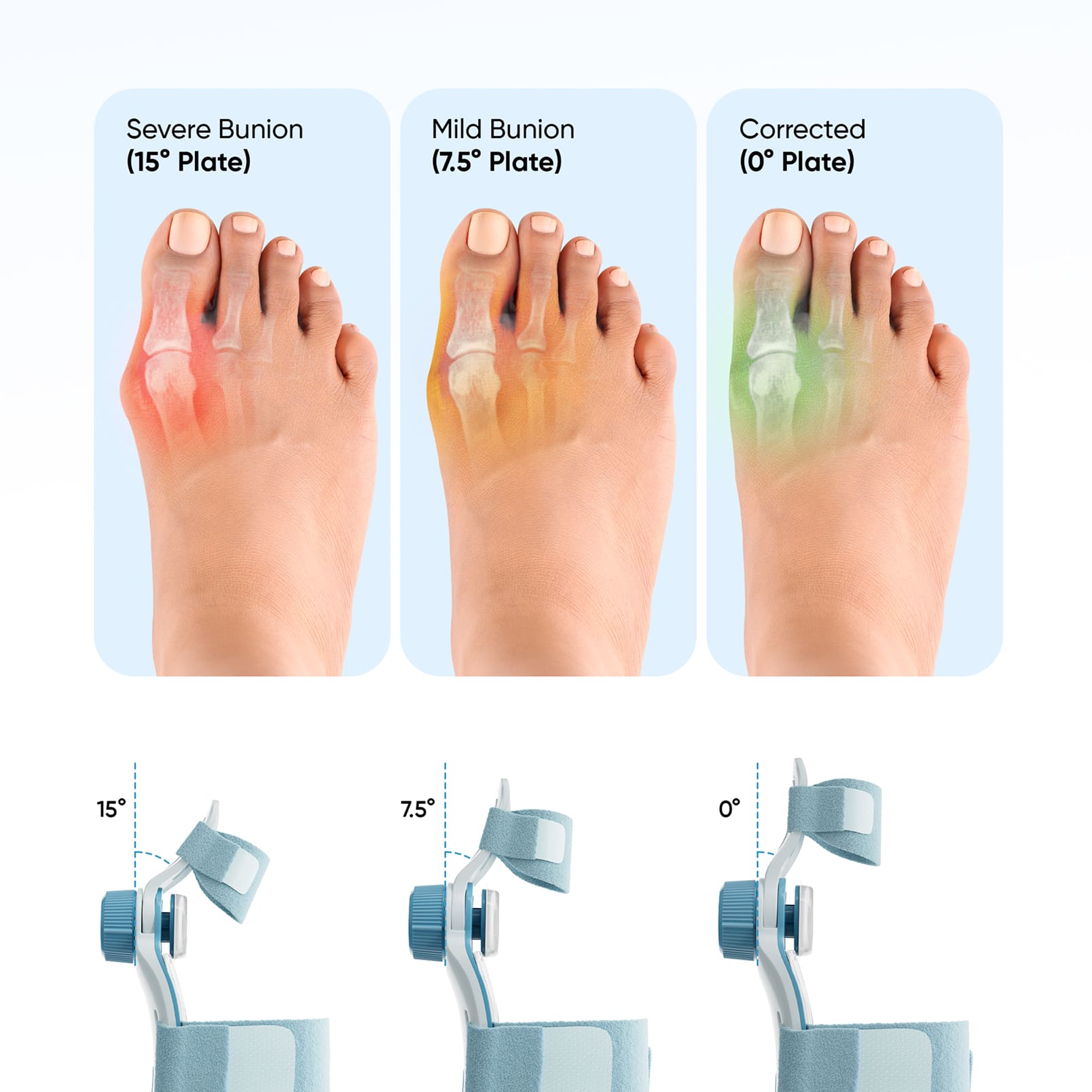 Bunion Corrector